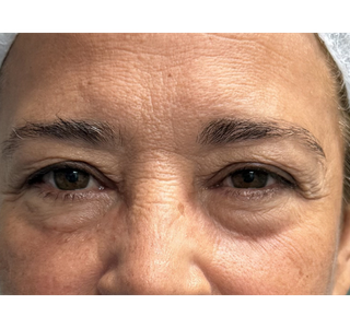 Antes - Dra. Iasmin Ledo