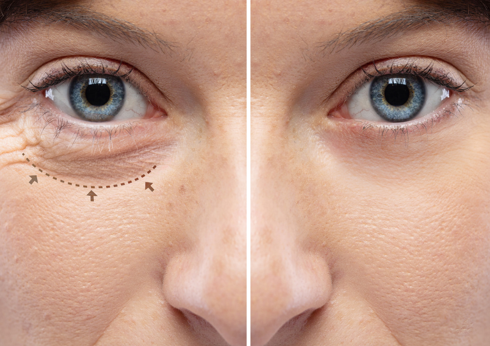 Dra. Iasmin Ledo - Cirurgia de Pálpebras Salvador BA